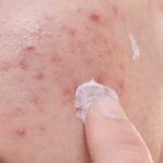 How to Treat Skin Infections Naturally with Simple Remedies | SkinCare Experts