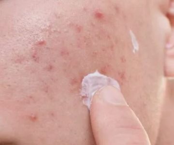How to Treat Skin Infections Naturally with Simple Remedies | SkinCare Experts