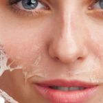 How to Treat Skin Peels and Flakes with Moisturizers