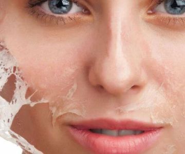 How to Treat Skin Peels and Flakes with Moisturizers