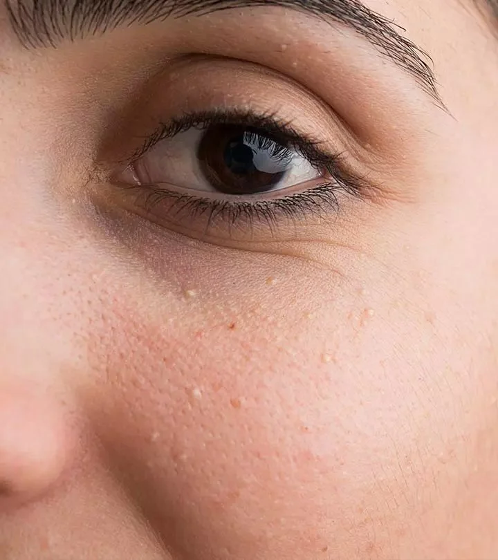 How to Get Rid of Milia and Prevent Future Breakouts