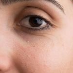How to Get Rid of Milia and Prevent Future Breakouts