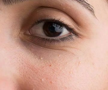 How to Get Rid of Milia and Prevent Future Breakouts