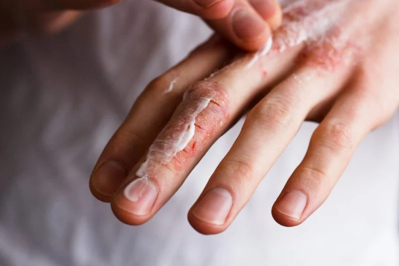 The Best Skincare Routine for Healing Dry, Cracked Skin: Expert Tips and Solutions