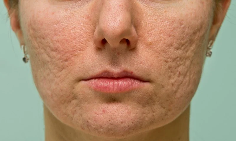 How to Treat and Prevent Skin Discoloration from Acne Scarring