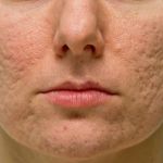 How to Treat and Prevent Skin Discoloration from Acne Scarring