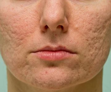 How to Treat and Prevent Skin Discoloration from Acne Scarring