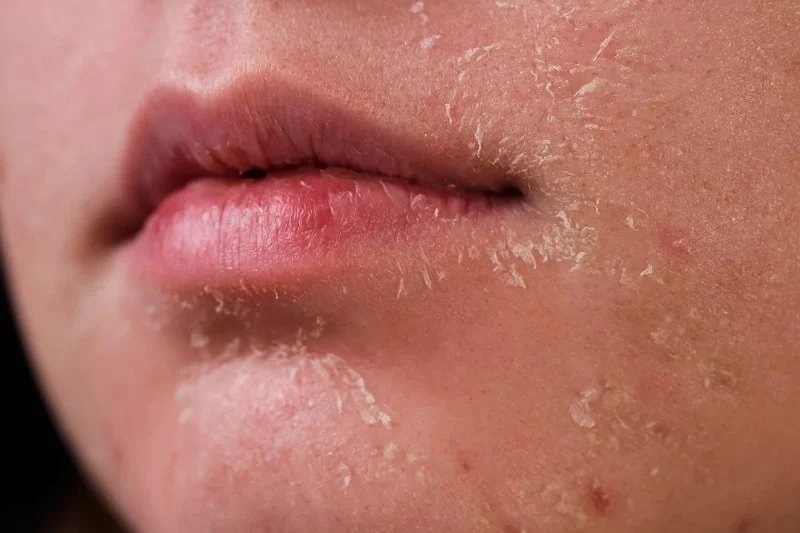 How to Treat and Prevent Skin Dryness During the Winter Months