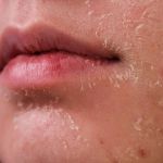 How to Treat and Prevent Skin Dryness During the Winter Months