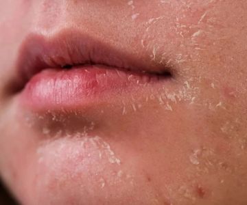 How to Treat and Prevent Skin Dryness During the Winter Months