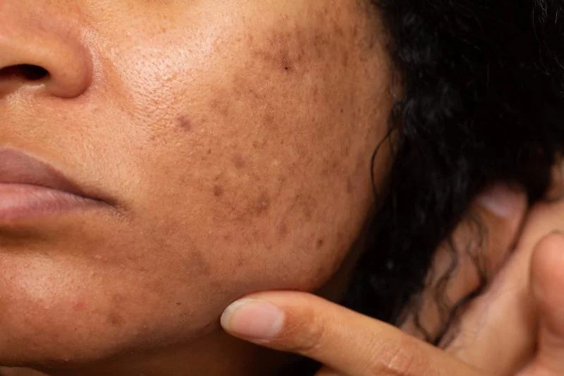 How to Treat Pigmentation and Dark Spots with Skin Care Products
