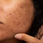 How to Treat Pigmentation and Dark Spots with Skin Care Products