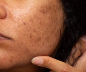 How to Treat Pigmentation and Dark Spots with Skin Care Products