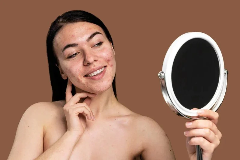 The Best Skincare Routine for Acne-Prone Skin in Your 20s