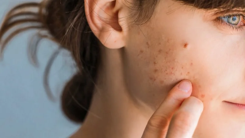 How to Get Rid of Acne and Pimples with a Simple Skincare Regimen