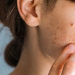 How to Get Rid of Acne and Pimples with a Simple Skincare Regimen