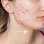 How to Treat Acne Scars: The Best Treatments and Home Remedies