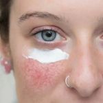 The Best Skin Care Products for Treating Rosacea and Redness