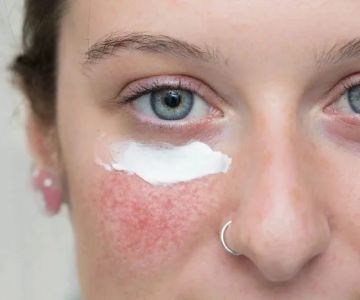 The Best Skin Care Products for Treating Rosacea and Redness
