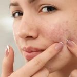 How to Treat Acne with Tea Tree Oil: What You Need to Know