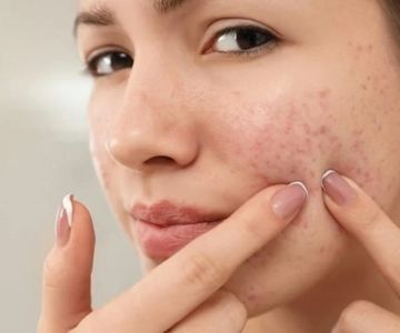How to Treat Acne with Tea Tree Oil: What You Need to Know