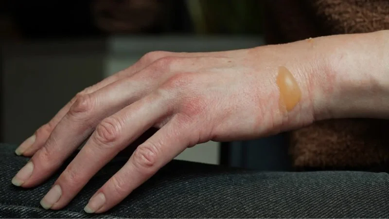 How to Treat Skin Burns with Simple Skin Care Techniques