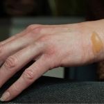 How to Treat Skin Burns with Simple Skin Care Techniques