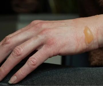 How to Treat Skin Burns with Simple Skin Care Techniques
