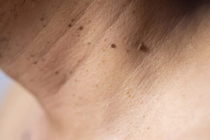 How to Get Rid of Skin Tags: Treatment and Prevention Tips