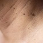 How to Get Rid of Skin Tags: Treatment and Prevention Tips