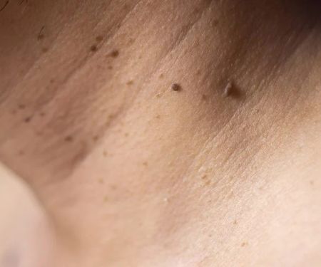 How to Get Rid of Skin Tags: Treatment and Prevention Tips