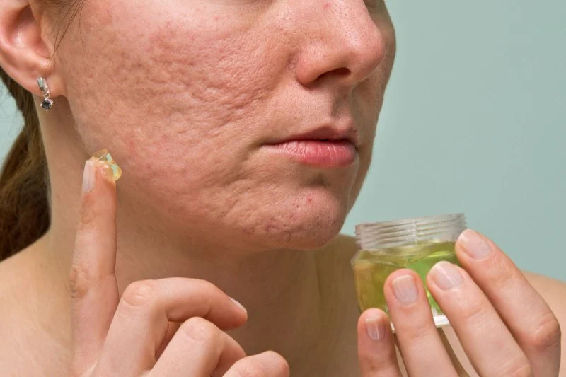 How to Treat and Prevent Acne Scars with Targeted Skincare Products