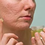 How to Treat and Prevent Acne Scars with Targeted Skincare Products