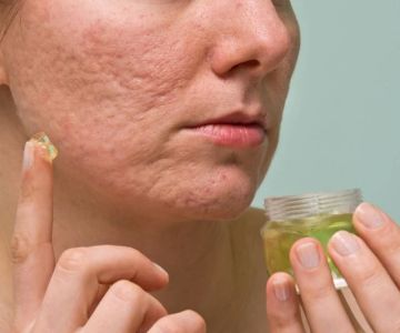 How to Treat and Prevent Acne Scars with Targeted Skincare Products