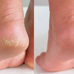 How to Get Rid of Dry, Cracked Skin on Your Hands and Feet