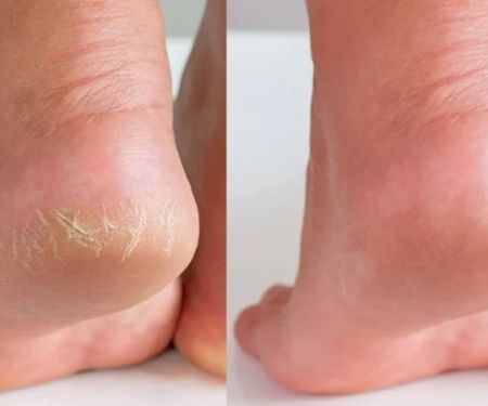 How to Get Rid of Dry, Cracked Skin on Your Hands and Feet