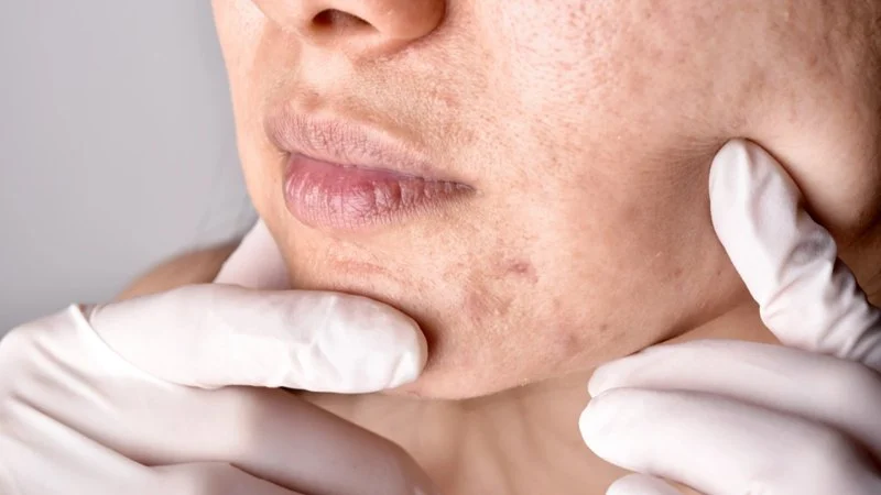 How to Treat Skin Problems Caused by Hormonal Changes with Skincare