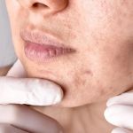 How to Treat Skin Problems Caused by Hormonal Changes with Skincare