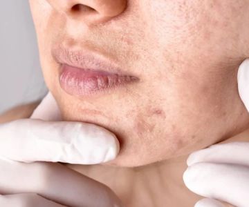 How to Treat Skin Problems Caused by Hormonal Changes with Skincare