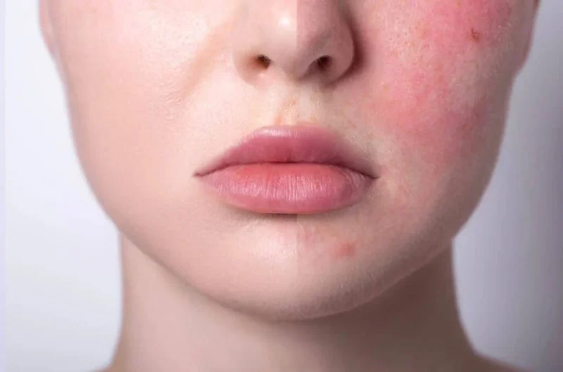 How to Treat Skin Allergies with Gentle Skin Care Solutions