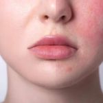How to Treat Skin Allergies with Gentle Skin Care Solutions