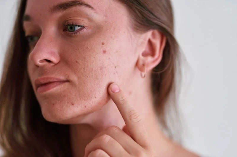 Best Skin Care Treatments for Reducing Acne and Breakouts: Top Solutions for Clearer Skin