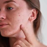 Best Skin Care Treatments for Reducing Acne and Breakouts: Top Solutions for Clearer Skin