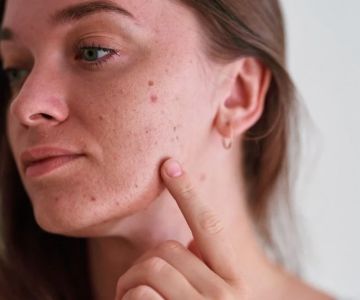 Best Skin Care Treatments for Reducing Acne and Breakouts: Top Solutions for Clearer Skin