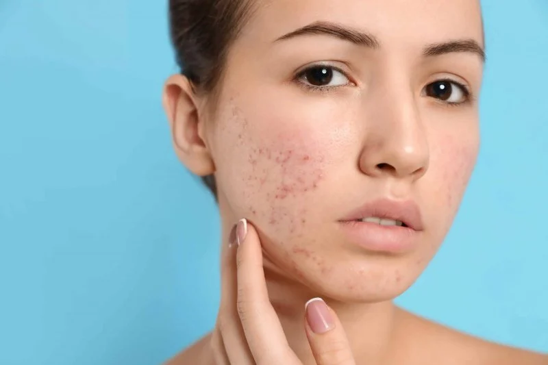 How to Treat Acne Marks with Natural Skin Care Remedies