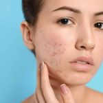 How to Treat Acne Marks with Natural Skin Care Remedies