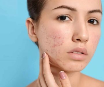 How to Treat Acne Marks with Natural Skin Care Remedies