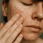 How to Treat Acne Scars and Hyperpigmentation Naturally