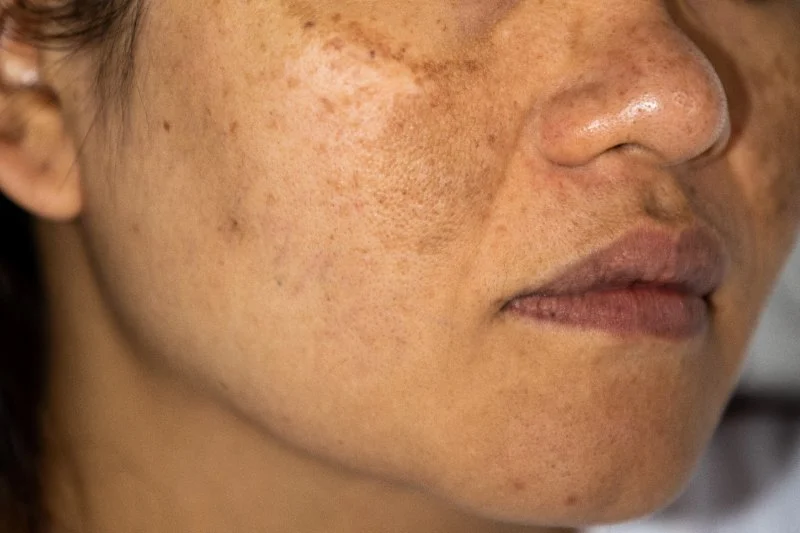 How to Treat Hyperpigmentation Naturally with Home Remedies
