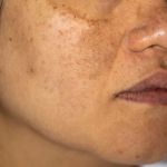 How to Treat Hyperpigmentation Naturally with Home Remedies